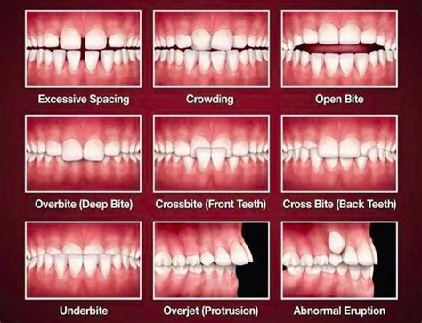 Malocclusion - difference between overbite, overjet and open bite | News | Dentagama