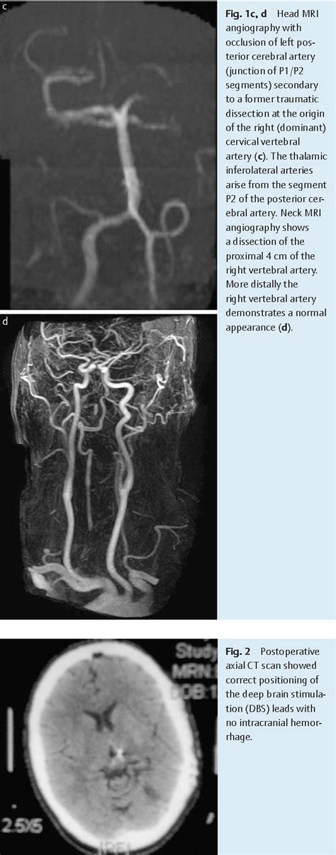 Figure 2 from Deep Brain Stimulation for Dejerine-Roussy Syndrome ...