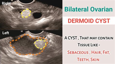 Bilateral Ovarian Dermoid Cyst | Treatment | Complications | Ultrasound - YouTube