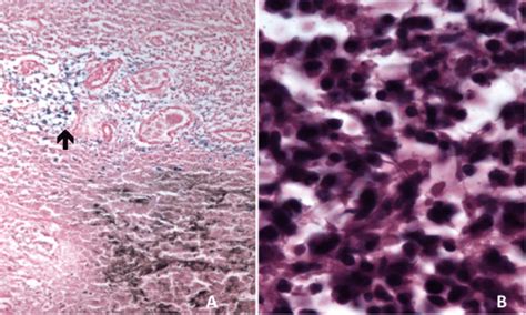 Microscopic examination of the lesions. A: haemosiderin deposits are... | Download Scientific ...