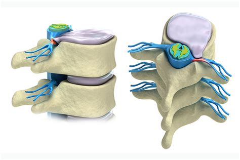 spinal cord injury stem cell treatment | Adult Stem Cell Therapy Abroad ...