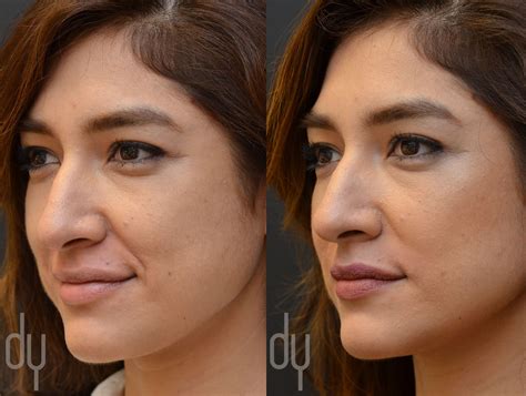 Before and After treating Nasolabial Fold (smile lines) with Juvederm Ultra. Patient desired a ...