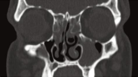 Improvements in Sinus Opacification | DUPIXENT® (dupilumab)