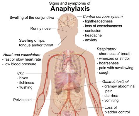 File:Signs and symptoms of anaphylaxis.png - Wikipedia