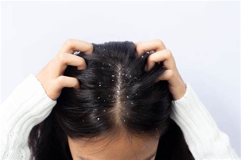 Why Do I Have Dandruff? 4 Major Causes You Should Know | Svenson