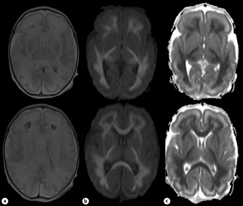 T2-weighted MRI (a), diffusion weighted image (b) with apparent... | Download Scientific Diagram