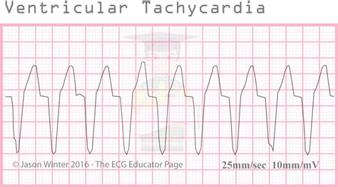 ECG Educator Blog : Ventricular Rhythms