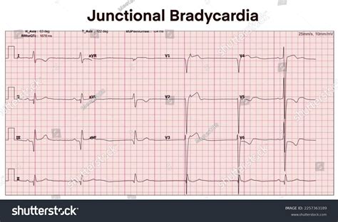 Electrocardiogram Show Junctional Bradycardia Heart Beat Stock Illustration 2257363189 ...