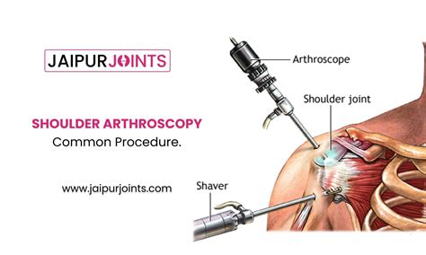 Shoulder Arthroscopic: Common procedures by Dr Lalit Modi | JaipurJoints