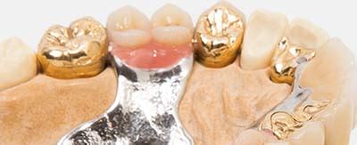 Dental Gold Buyer - Vancouver GoldVancouver Gold