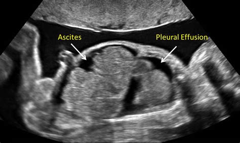 Pleural Effusion Fetal Ultrasound