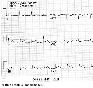 ECG Learning Center - An introduction to clinical electrocardiography