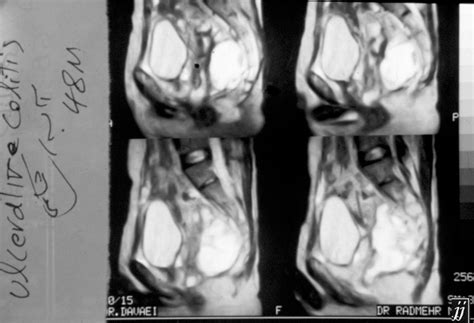 Radioogle | Abdomen- ulcerative colitis, abdominal abscess, 48M (2)