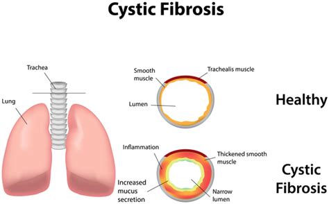 Cystic fibrosis: MedlinePlus Genetics