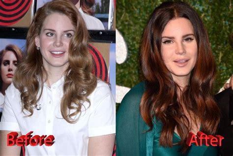 Lana Del Rey Plastic Surgery Before and After Lady Gaga Nose, Cheek ...