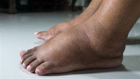 Are Swollen Feet A Sign Of Heart Failure?, 60% OFF