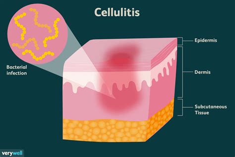 Cellulitis Treatment Cream