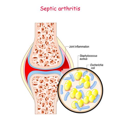 6 Risk Factors of Septic Arthritis You Must Know | Vejthani