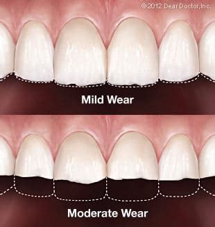 Tooth Wear: Causes, Symptoms, & Treatment