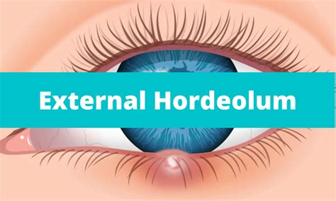 External Hordeolum (Stye) | Medical Junction