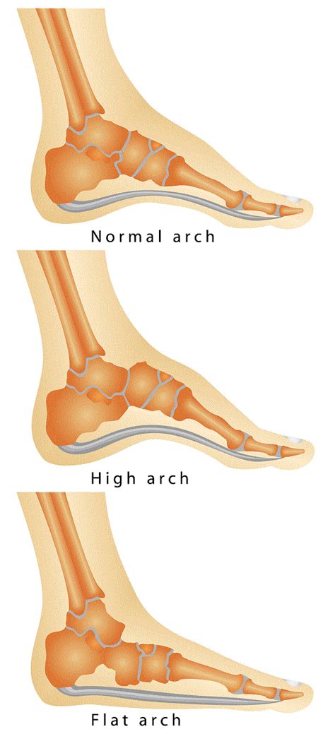 Foot Pain & Arch Height | Burlington Treatment | Physio