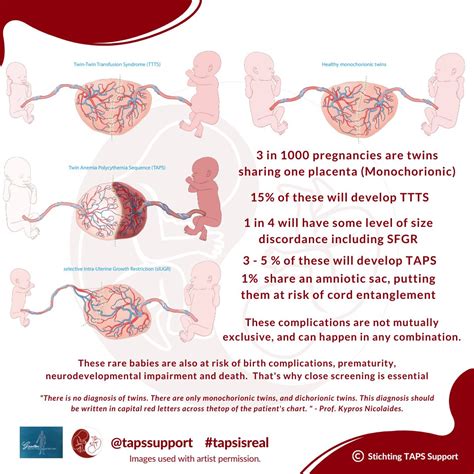 What Are The Complications Of Having Twins