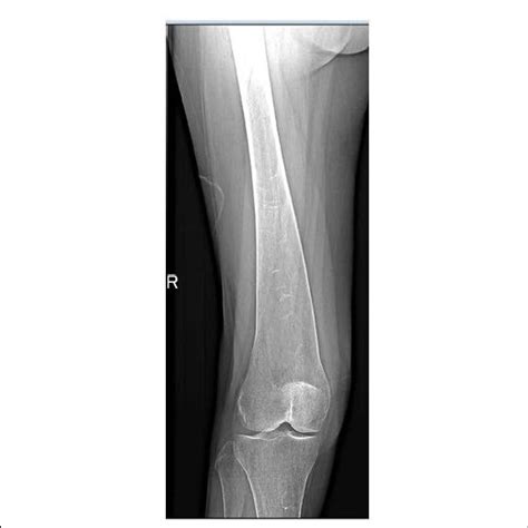 Erlenmeyer Flask Sign of the Femur | Download Scientific Diagram