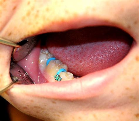 What are Separators, Spacers and Orthodontic Bands? - Ask an Orthodontist.com