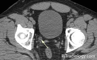 RiT radiology: Perinephric Stranding with Dilated Ureter