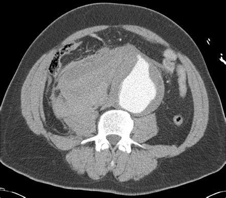 Retroperitoneal Aortic Exposure