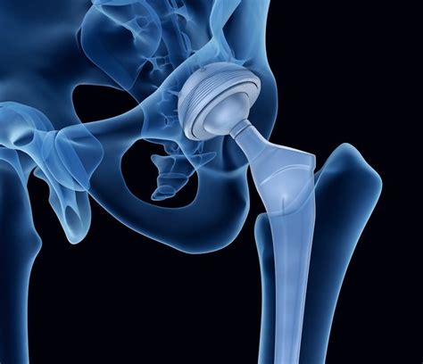 Dislocation following hip replacement surgery - Dr. Anthony Spriggins