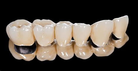 What is a Dental Bridge? Types, Costs, Pros & Cons.