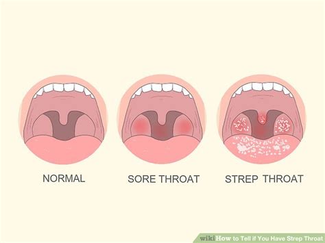 How to Tell if You Have Strep Throat (with Pictures) - wikiHow