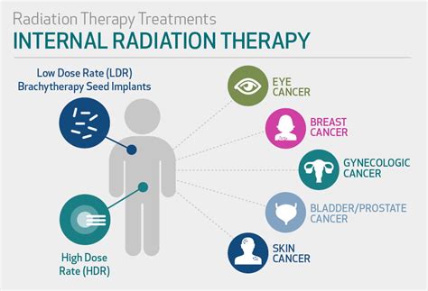 Radiation Therapy | Houston Methodist