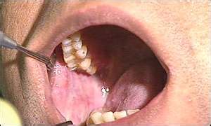 BBC News | HEALTH | Chewing tobacco cancer warning