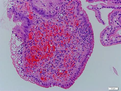 Pathology Outlines - Portal hypertensive gastropathy