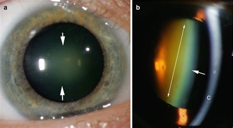 The Crystalline Lens | Ento Key