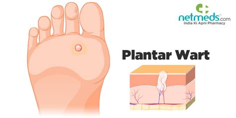 Plantar Wart/Foot Wart: Causes, Symptoms And Treatment