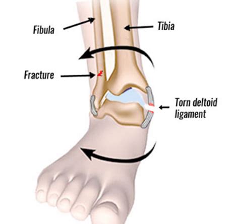 Medial Ankle Sprainhttps://static.wixstatic.com/media/23ac3b ...