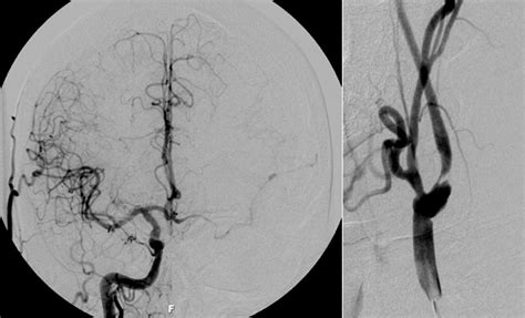 Carotid and Cerebral Angiography | X-Ray Medical Group Grossmont Imaging La Mesa, Santee CA