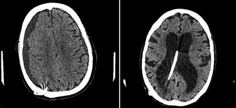 Shunt complications and opening pressure - Neurosurgery Blog