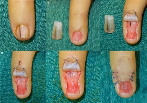 RACGP - Pigmented lesions of the nail bed – Clinical assessment and biopsy