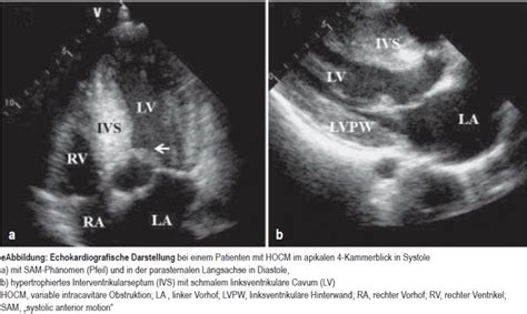 Hypertrophe obstruktive Kardiomyopathie