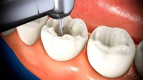 What To Expect When Getting A Root Canal | Marx Family Dental