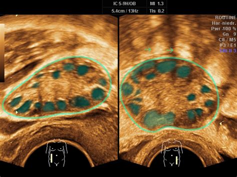 Normal Vs Polycystic Ovaries Ultrasound