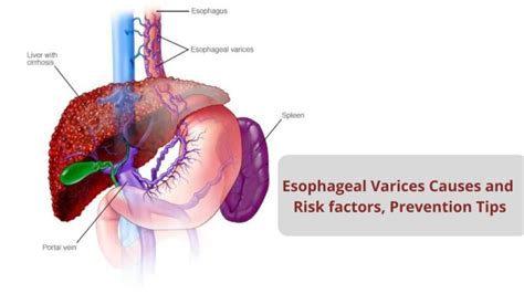 Esophageal Varices Causes Risk Factors And Prevention Tips Vims | The ...