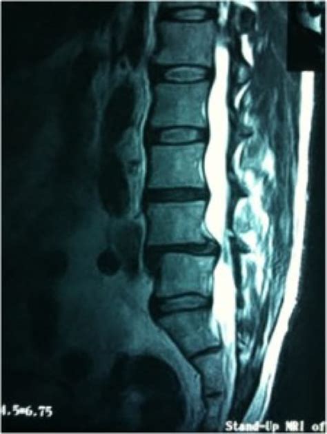 Grade 1 Spondylolisthesis | OrthoManhattan