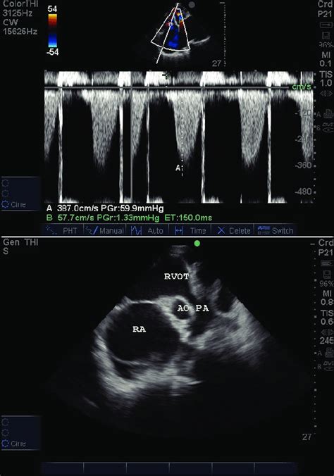 Echocardiogram showing moderately severe pulmonary arterial hypertension. | Download Scientific ...