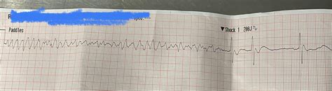 V-Fib or torsades? : r/EKGs