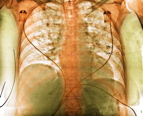 Aspiration Pneumonia Mistaken for Community- Acquired Pneumonia ...